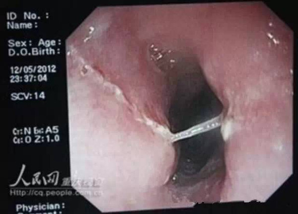 海姆立克急救法:鱼刺卡到喉咙别拍背! 海姆立克急救法:鱼刺卡到喉咙别拍背!